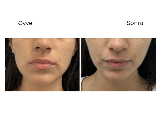 Candela Vbeam Perfecta